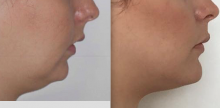 CIRURGIA ORTOGNÁTICA