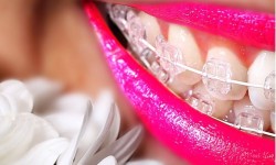 BRÁQUETES ESTÉTICOS