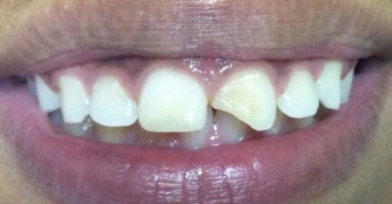 Fraturas dentárias